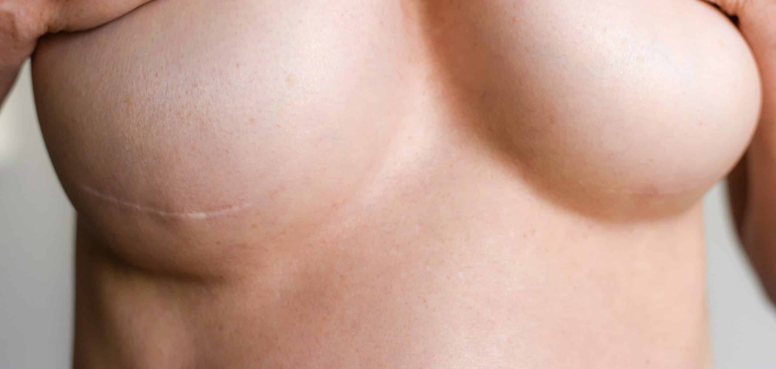 Combien de séances pour un traitement laser des cicatrices ? | Centre Laserio | Paris 8