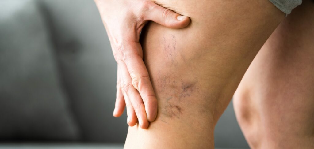 Les varices disparaissent-elles naturellement ? | Centre Laserio | Paris 8