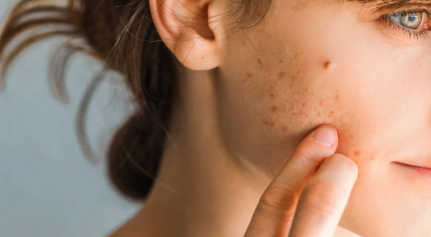 Comment supprimer les cicatrices d'acné ? | Centre Laserio | Paris 8