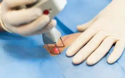 Un arrêt de travail est-il nécessaire pour un traitement laser des cicatrices ? | Centre Laserio | Paris 8